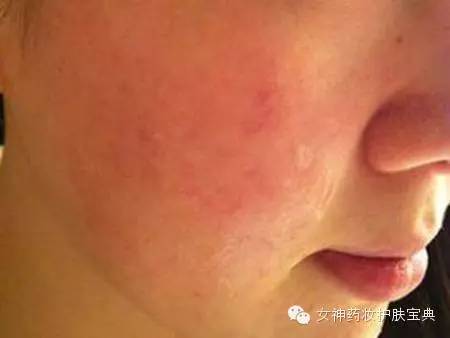 季节性脸部过敏，成因、症状与应对策略