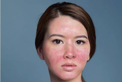 季节性脸过敏怎么办？全方位解析应对之策