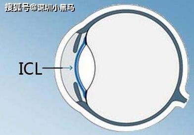 ICL手术与角膜内皮细胞，深入了解与应对之策