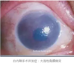 角膜内皮细胞读数的深度解析与应用