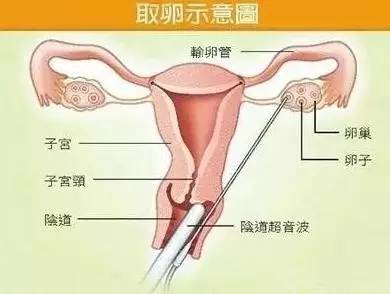 取卵后腹水移植流程详解