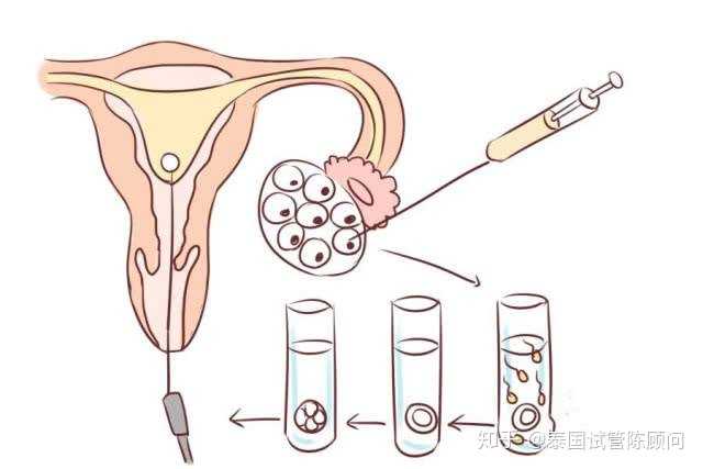 取卵后女性需要注意的事项
