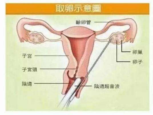 关于取卵数量与腹水风险的探讨——以取卵12个为例