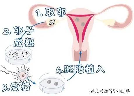 卵巢高会影响取卵吗？解析卵巢位置与取卵过程的关系