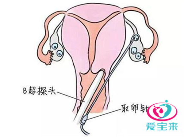 试管婴儿技术中的取卵时机，探索最佳时间点