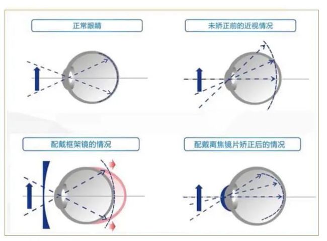 渐进多焦点镜片，真假之间的探索与解析