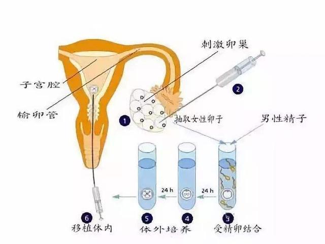 无痛取卵技术，现代生殖医学的新突破